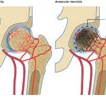 Avascular Necrosis